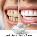 سفید کردن دندان با جوش شیرین امکان پذیر است؟ مزایا، روش صحیح
